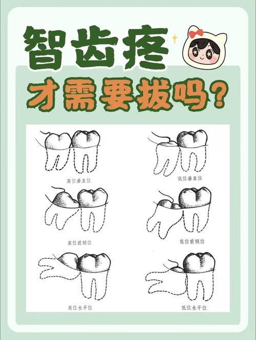 嘴里长了智齿一定要拔掉吗,嘴里长了颗智齿-第2张图片 嘴里长了智齿一定要拔掉吗,嘴里长了颗智齿-第2张图片